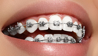 拔了八顆牙齒 矯牙后大變樣！