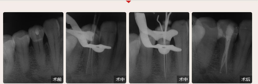 順德德倫口腔醫生全國根管治療技術競賽案例