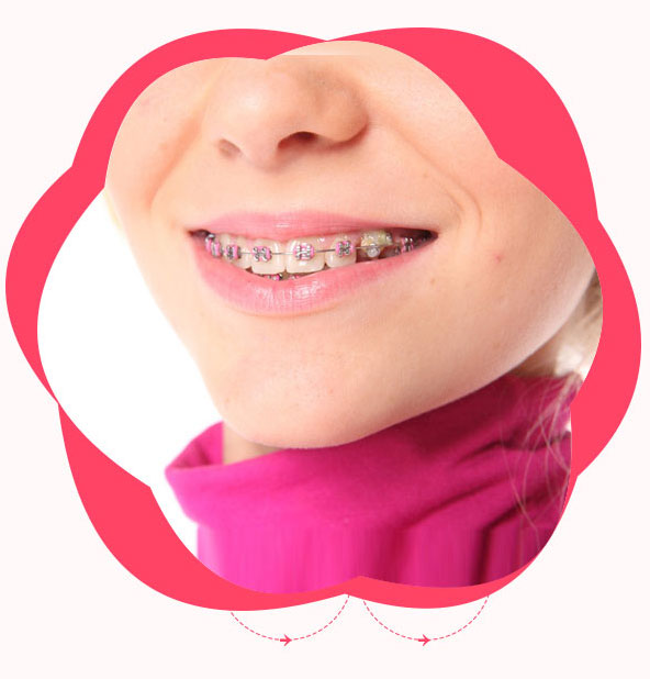 自鎖金屬托槽正畸