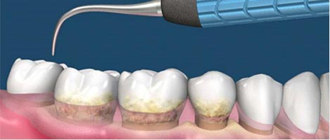 輕度牙周病治療方案齦上潔治