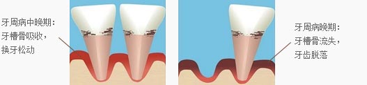 牙周病中晚期及晚期